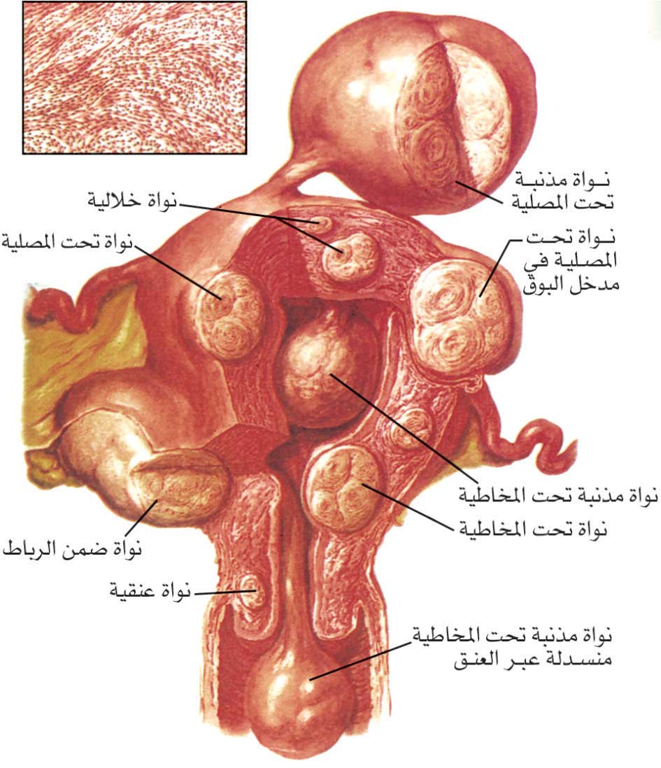 توضعات النويات الليفية المختلفة
