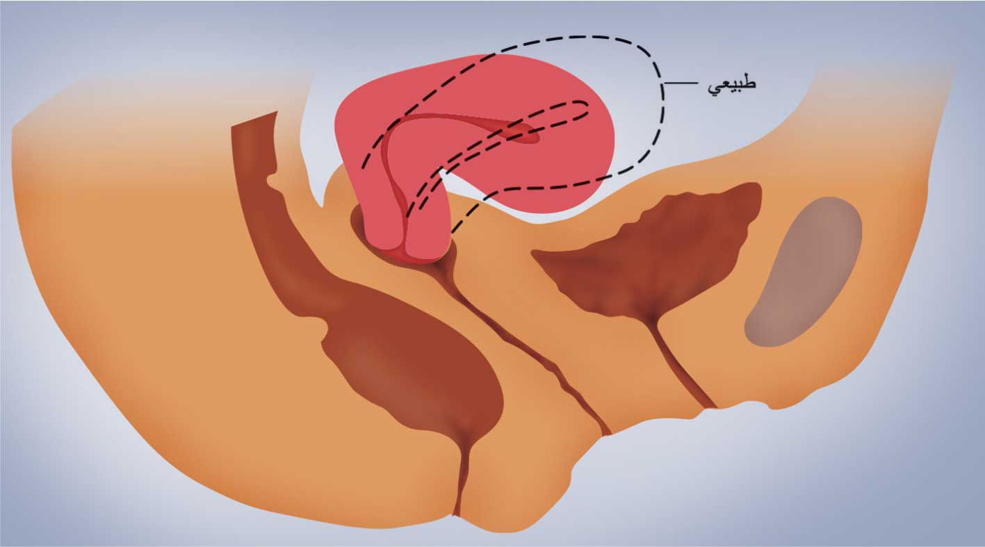 الانعطاف الأمامي