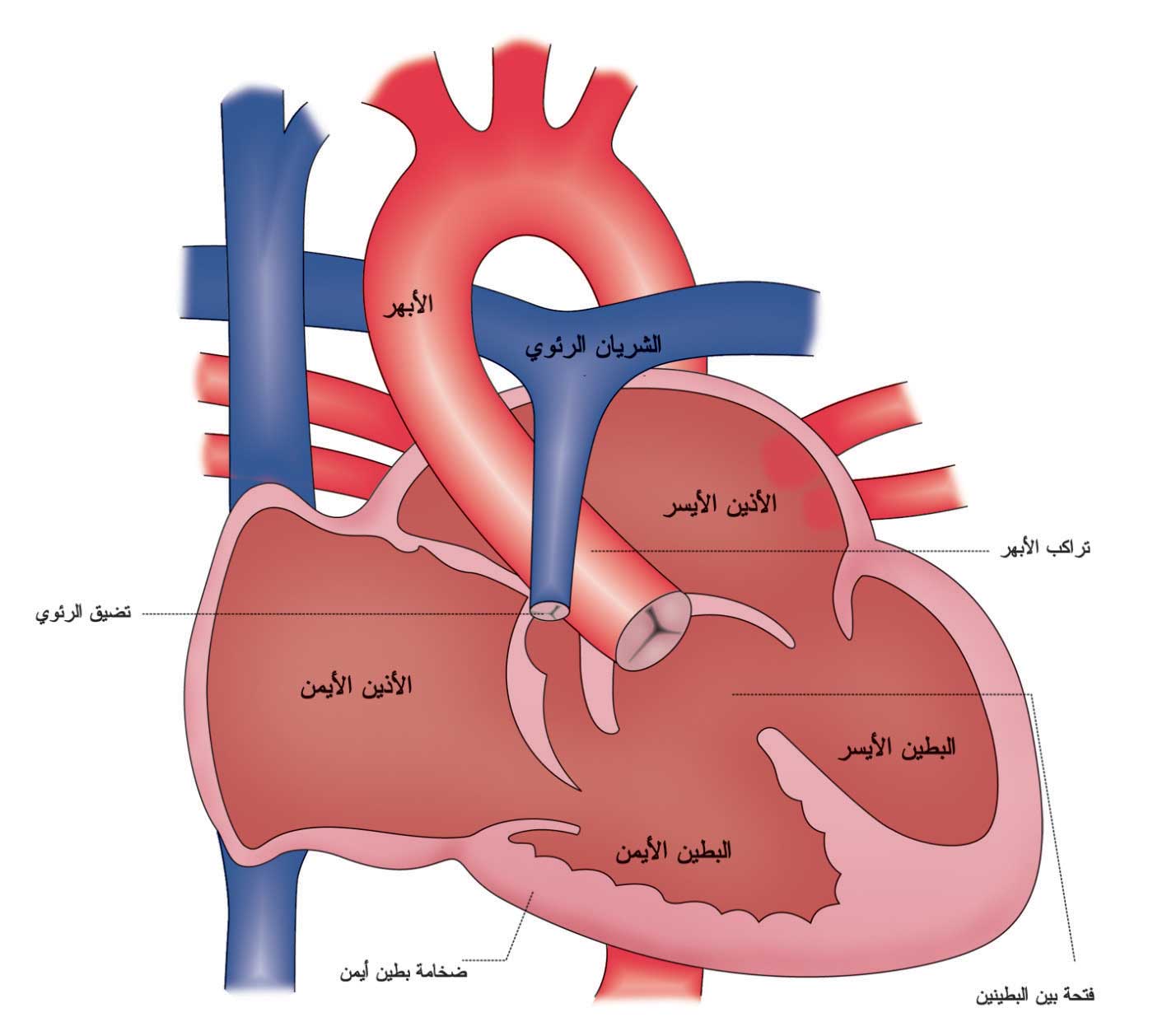 رباعية فالو