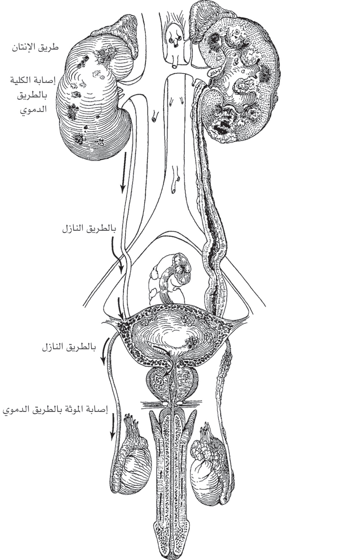 طرق إصابة الجهاز البولي
