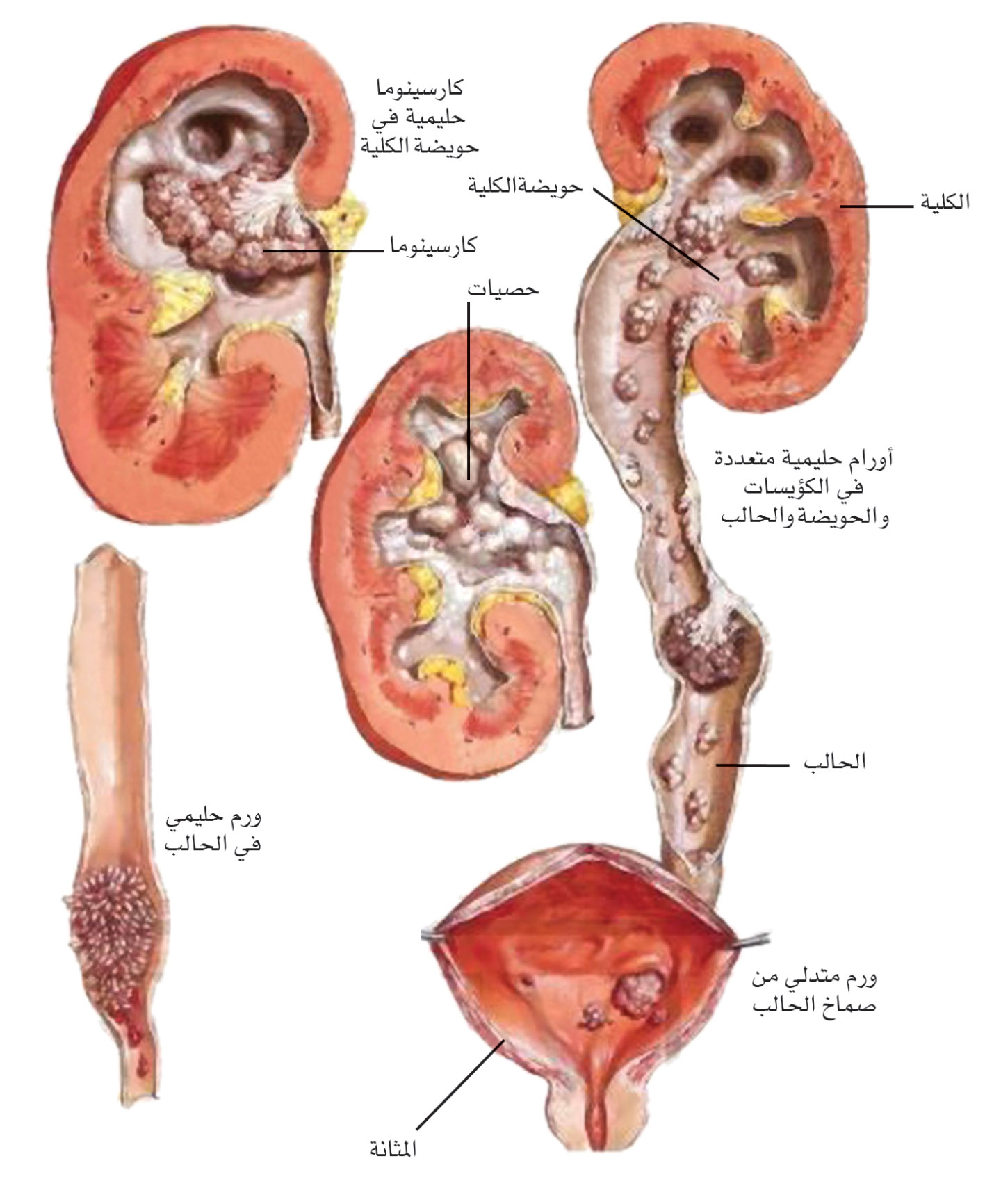 سرطانات جهاز البول
