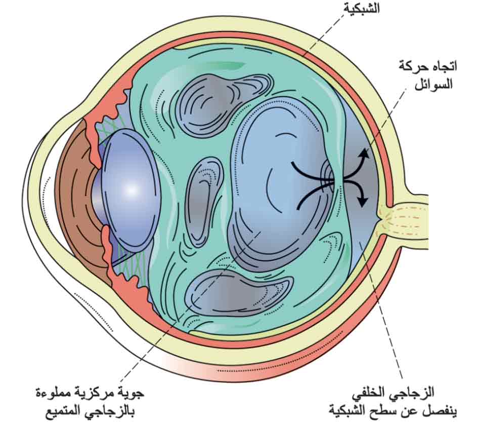 انفصال الزجاجي الخلفي