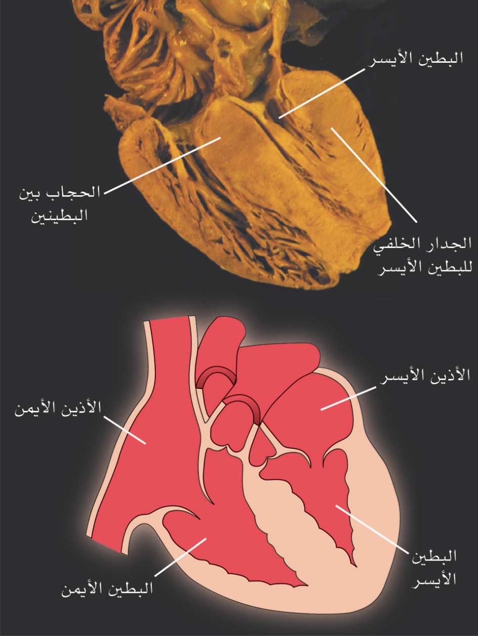 منظر تشريحي (في الأعلى) وترسيمي (في الأسفل) لاعتلال العضلة القلبية الضخامي